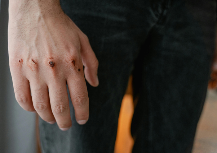 【萊沃醫(yī)療：知識(shí)分享】小傷口，大講究，別再不當(dāng)回事