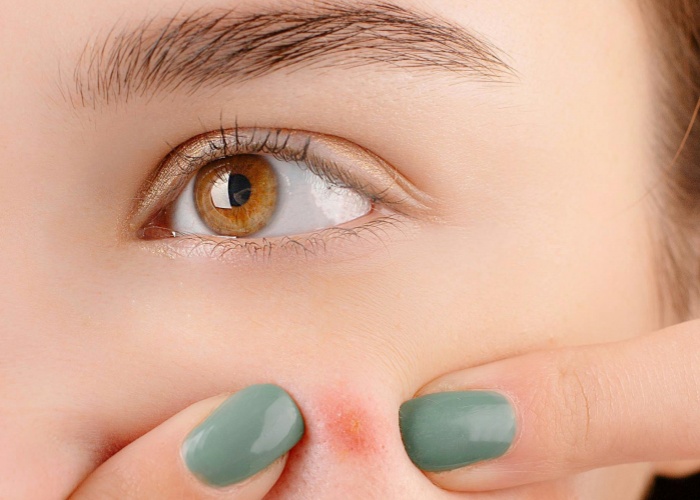 【萊沃醫(yī)療：知識分享】憑啥別人的痘像沒來過？而你的印子能寫三行詩？！