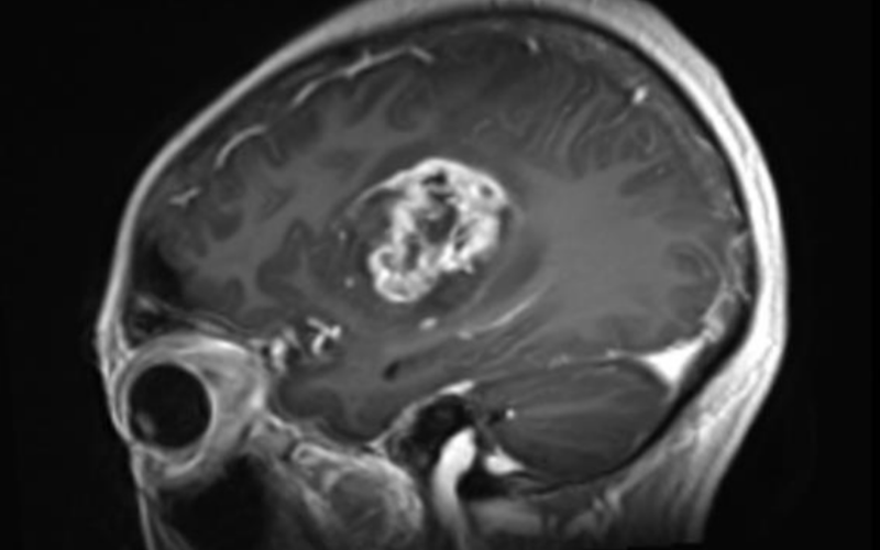 病例分享：重慶大學附屬腫瘤醫(yī)院神經(jīng)外科Endoport下切除左額深部基底節(jié)區(qū)膠質(zhì)瘤