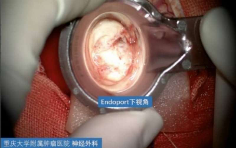 重慶大學附屬腫瘤醫(yī)院神經(jīng)外科手術(shù)集錦：Endoport下腦室巨大占位性病變切除術(shù)